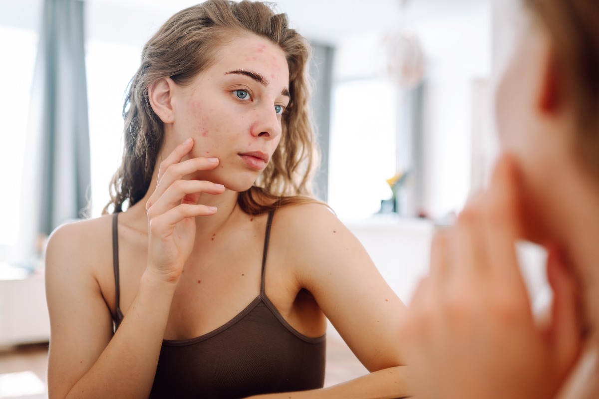 Ragazza con imperfezioni della pelle del viso